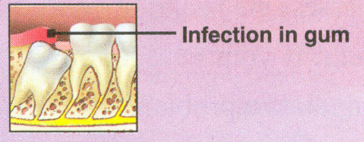 infected gum around wisdom tooth